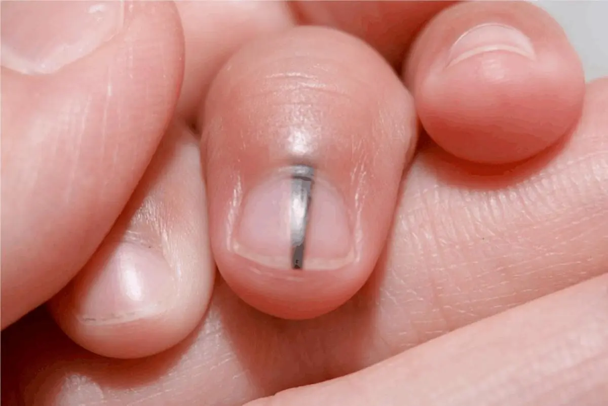 These 5 "dark spots" on your body may be warning signs of c.anc.er, signals most people ignore