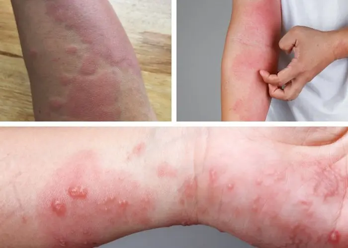 Is Dry, Itchy Skin in Winter Caused by Improper Bathing?