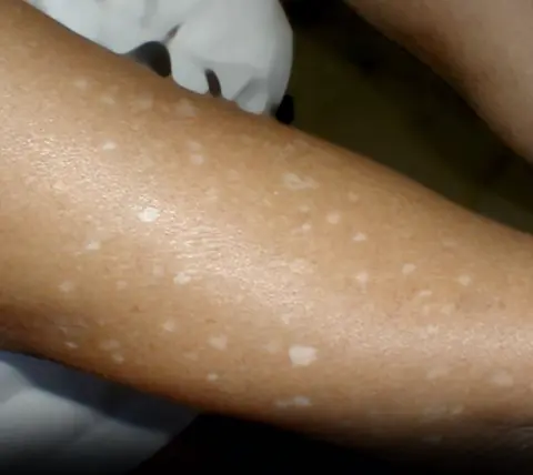 Have you noticed small white spots on your arms or legs… and you don't know what they are?
