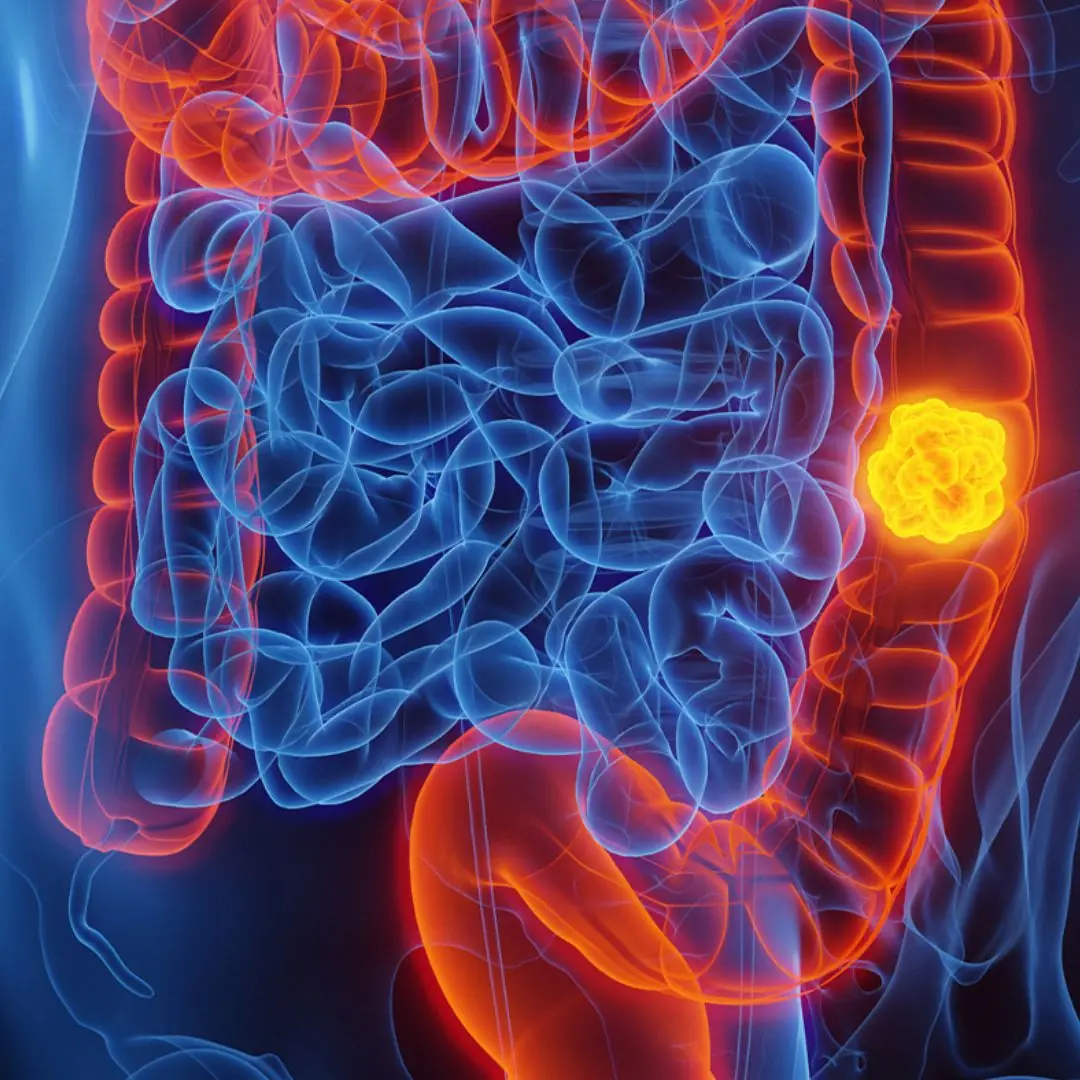 She Thought It Was Nothing: Woman with Stage - Four Colon Cancer Reveals 5 Symptoms She Overlooked