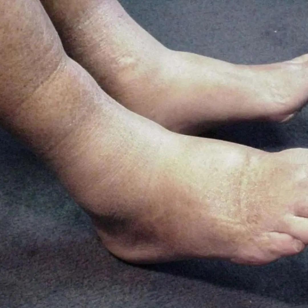 Your Legs Could Be Sending a Pancreatic Cancer Warning — 4 Signs to Watch