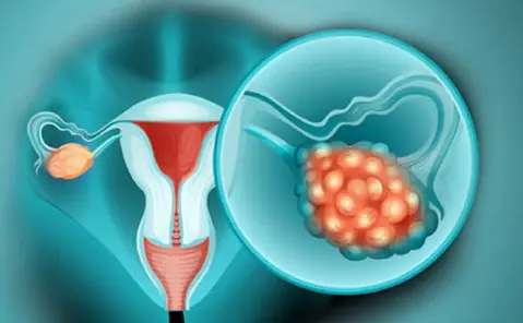 The link between ovarian can.cer and breast can.cer