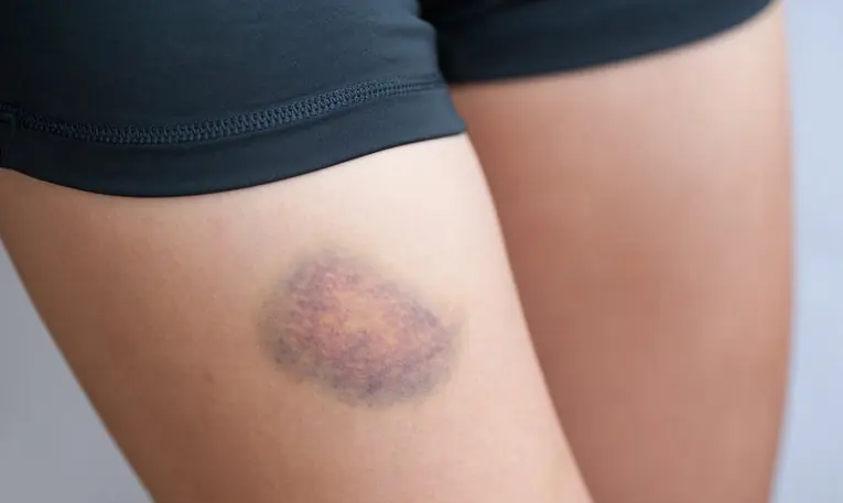 Here are some possible reasons you might be getting these bruises