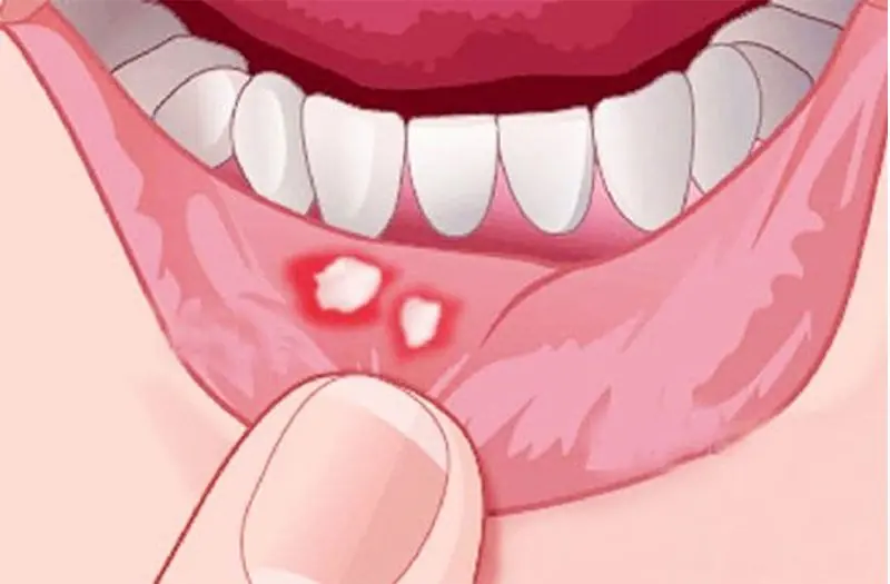 Frequent Mouth Ulcers in Winter: Don’t Ignore Them, as They May Signal Serious Health Issues