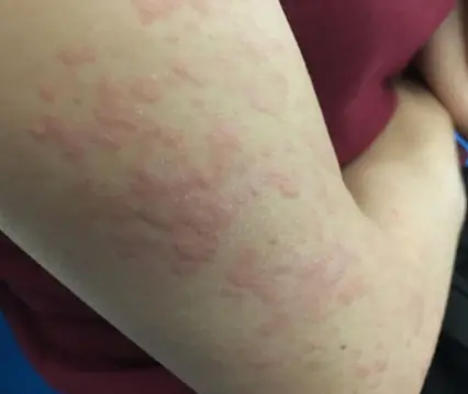 Surprising Causes Of Hives Revealed — What May Be Triggering Your Skin Reaction