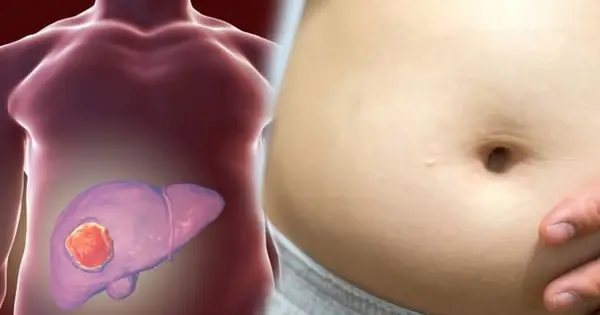 Big belly doesn't always mean fat: How to distinguish between belly fat and liv.er dis.ease