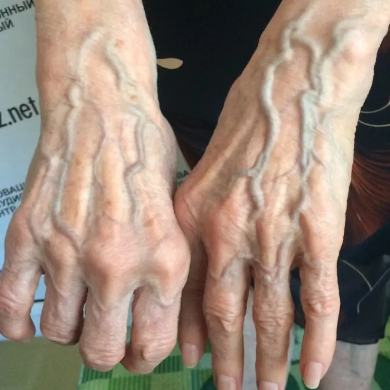 Seeing raised veins? Here’s what you should tell them right away.