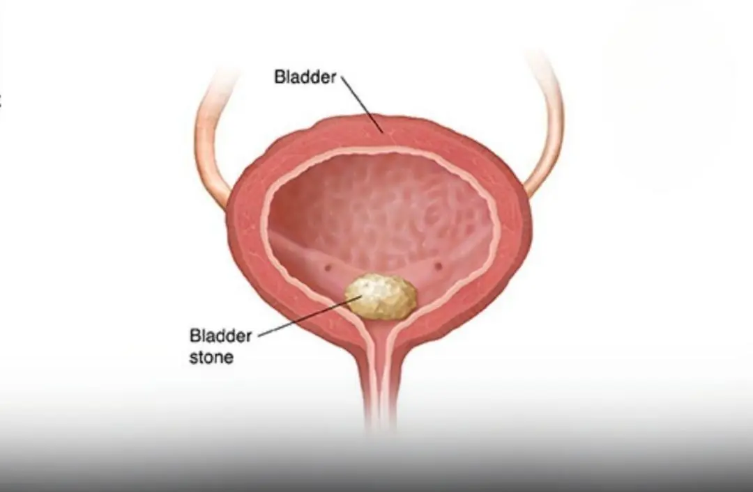 Doctors Warn: Early Indicators of Bladder Can.cer You Must Know