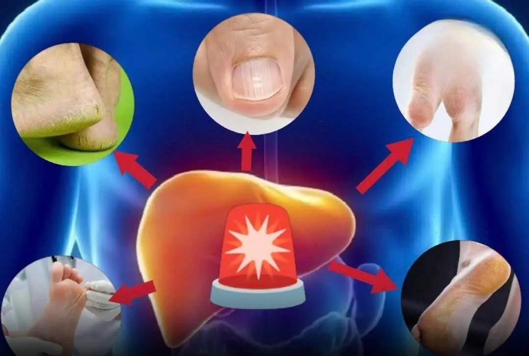 This Symptom in Your Feet Could Mean Fat.ty Liver Dis.ease Can’t Be Reversed