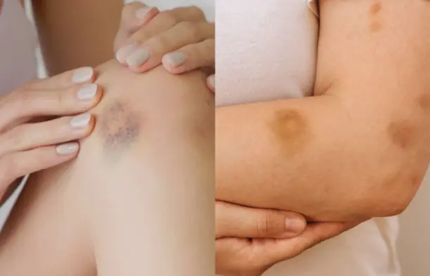 If You Get These Bruises on Your Body… Here’s What It Means