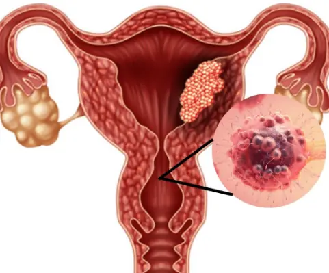 5 early warning signs of cervical cancer