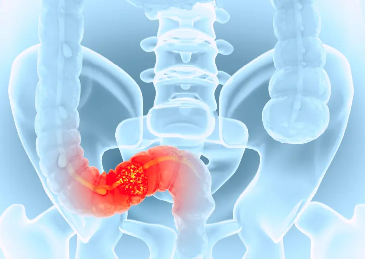 Dull abdominal pain, abdominal pain around the navel, be careful because you may have this disease