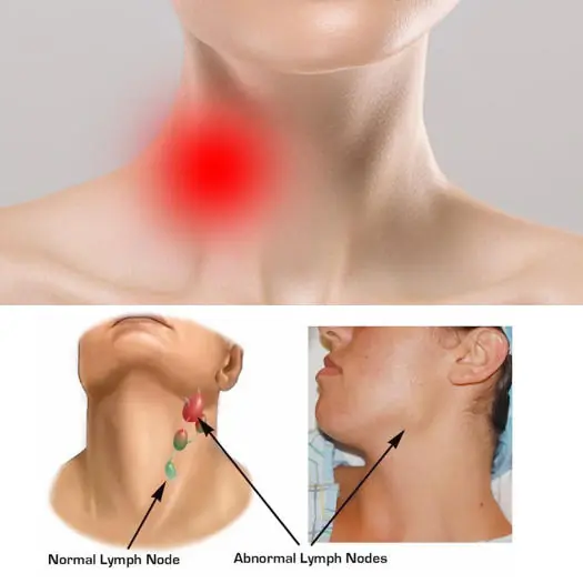 People about to have c.an.cer often have 3 signs in the neck, early examination still has a chance of treatment