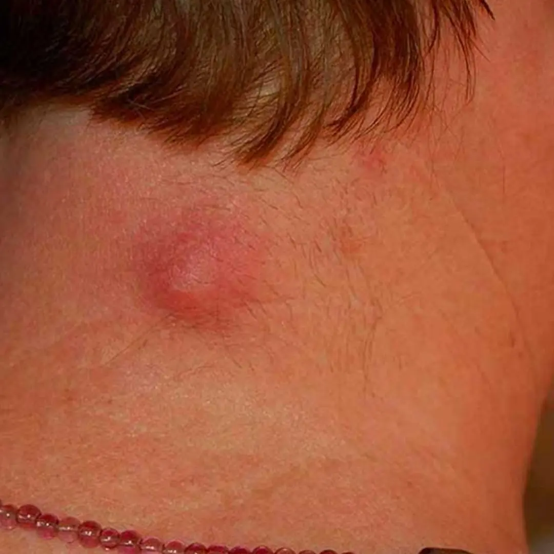 If you get a lump on your neck, back or behind your ear, it means you have ca...