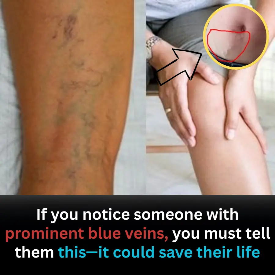 Prominent Blue Veins: A Silent Warning You Should Never Ignore