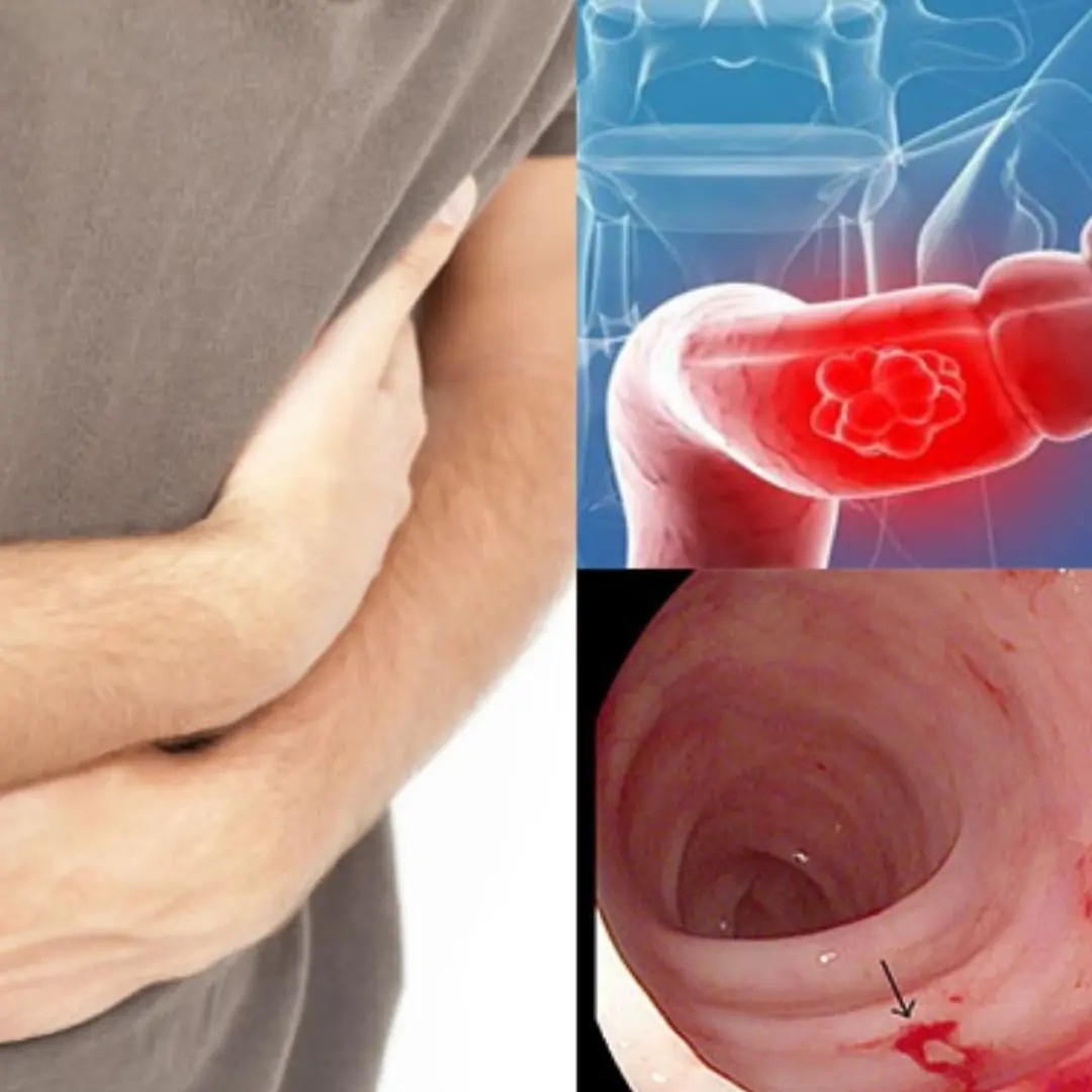 Cancer May Be Silent at First: 8 Warning Signs You Should Never Ignore When Using the Toilet