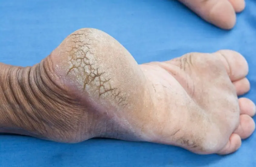 Pharmacist shares major wa:rning sign in heels of foot that could be symptom of serious condition