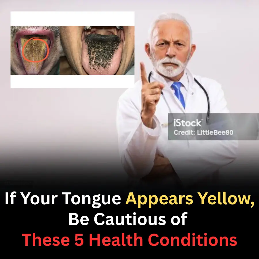 Yellow Tongue: A Small Sign That May Signal Serious Health Problems