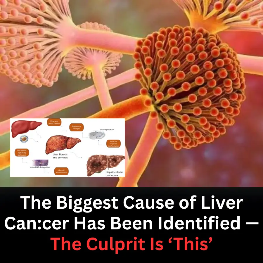 The Biggest Cause of Liver Cancer Identified: Doctors Point to a Common but Overlooked Culprit