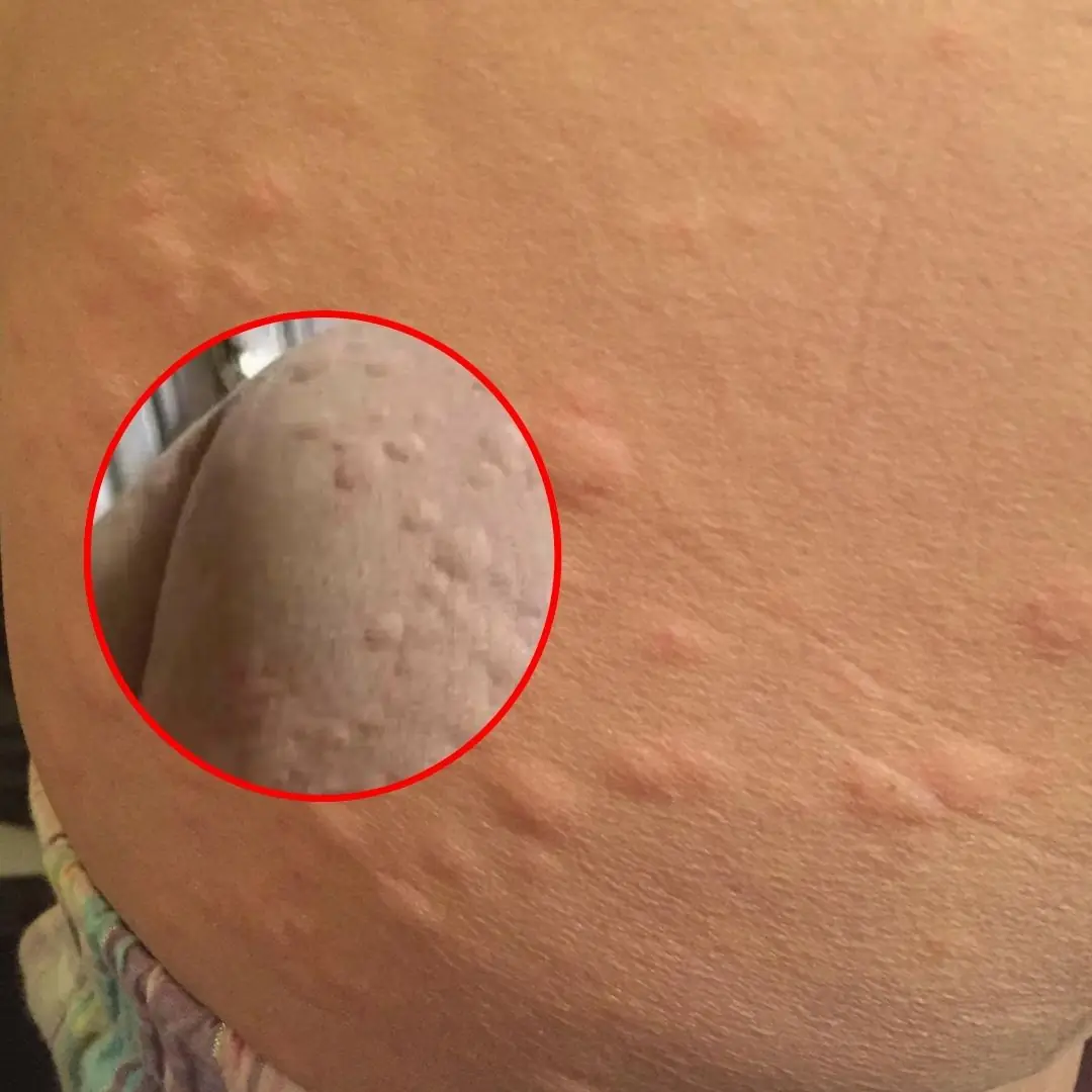 Warning signs: Persistent itching and small bumps on your skin may signal a hidden problem