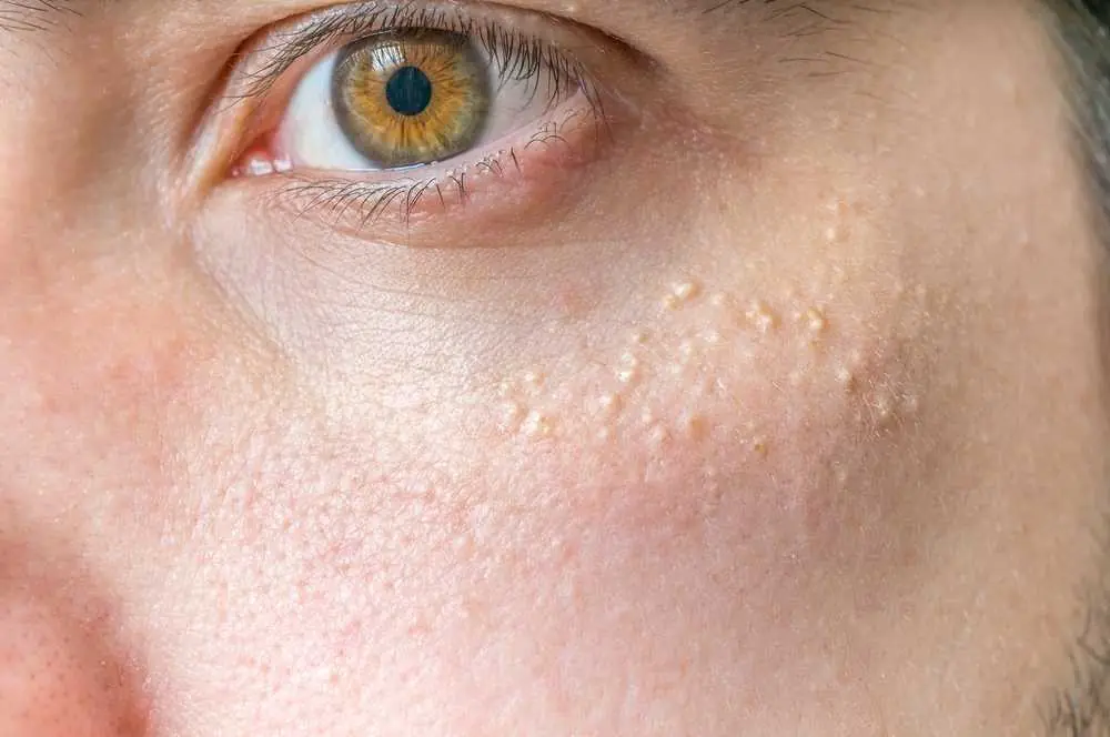 White Spots Around the Eyes: What Are They Really Telling You About Your Health?