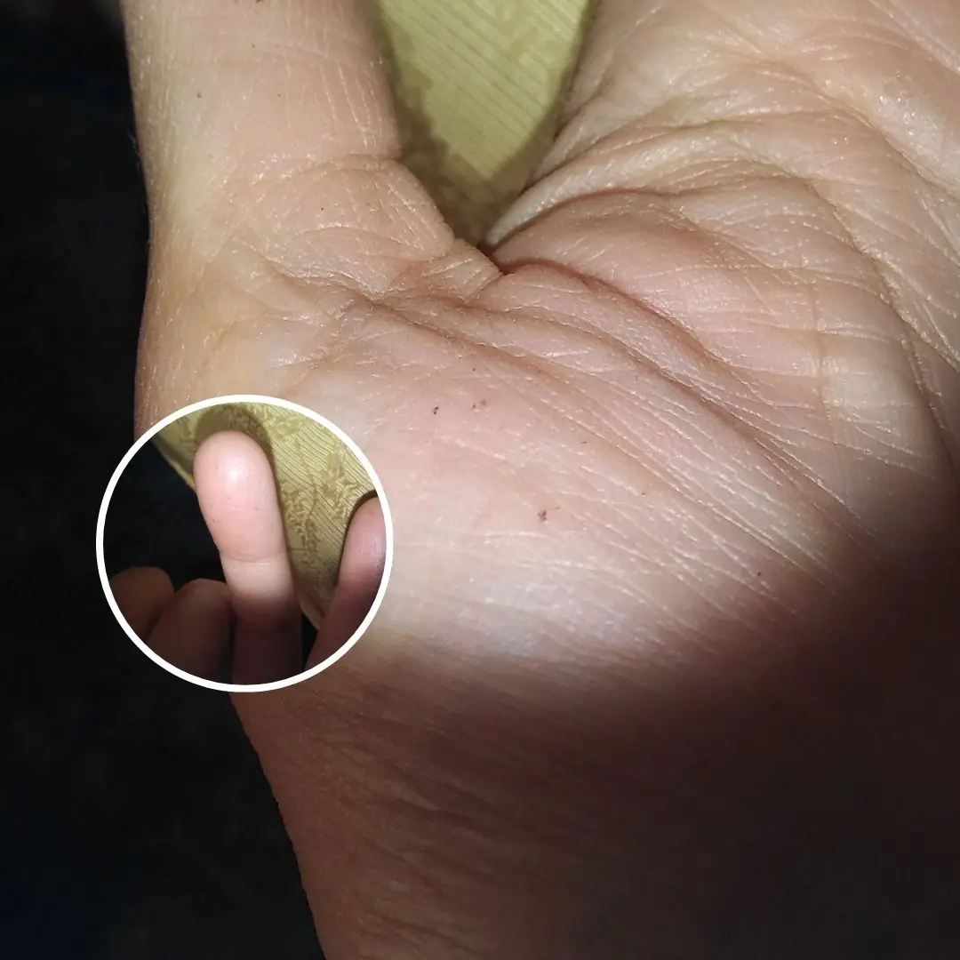 Red-Brown Speckles on Palms and Fingers: Harmless Marks or a Health Warning?