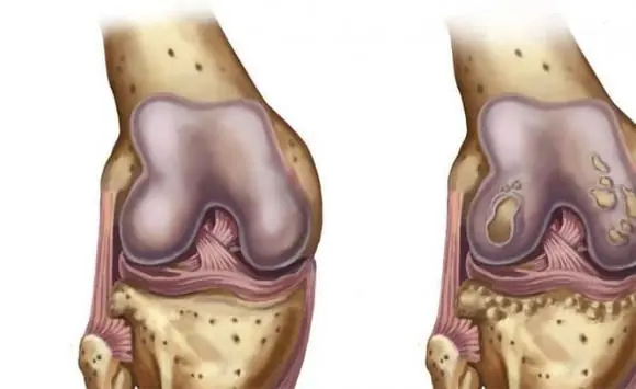 Three Drinks Known as “Calcium Depleters” That Many People Still Love: The More You Drink, the More Brittle Your Bones Become