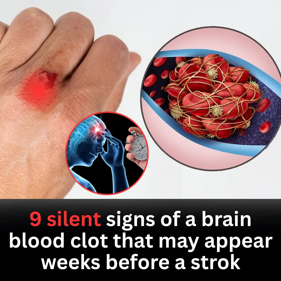 9 Silent Signs of a Brain Blood Clot That May Appear Weeks Before a Stroke