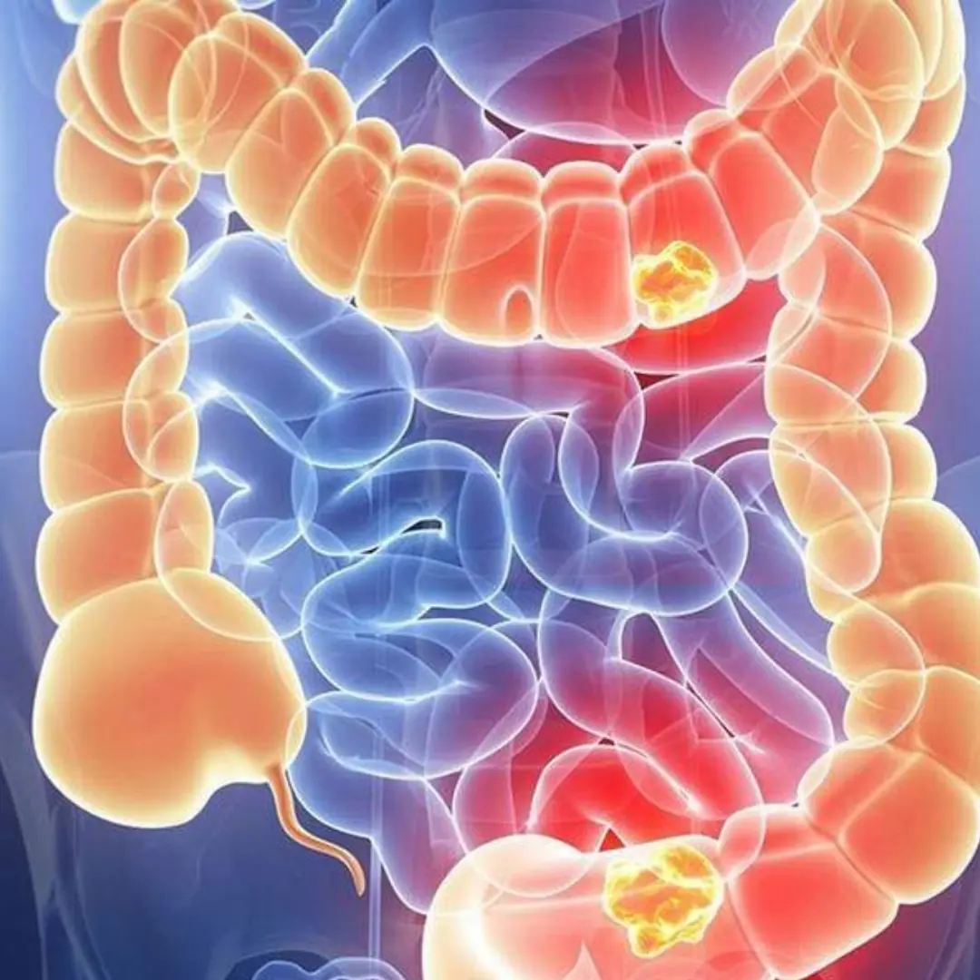 Woman diagnosed with stage four colon can.cer w.arns people about 5 symptoms she ignored