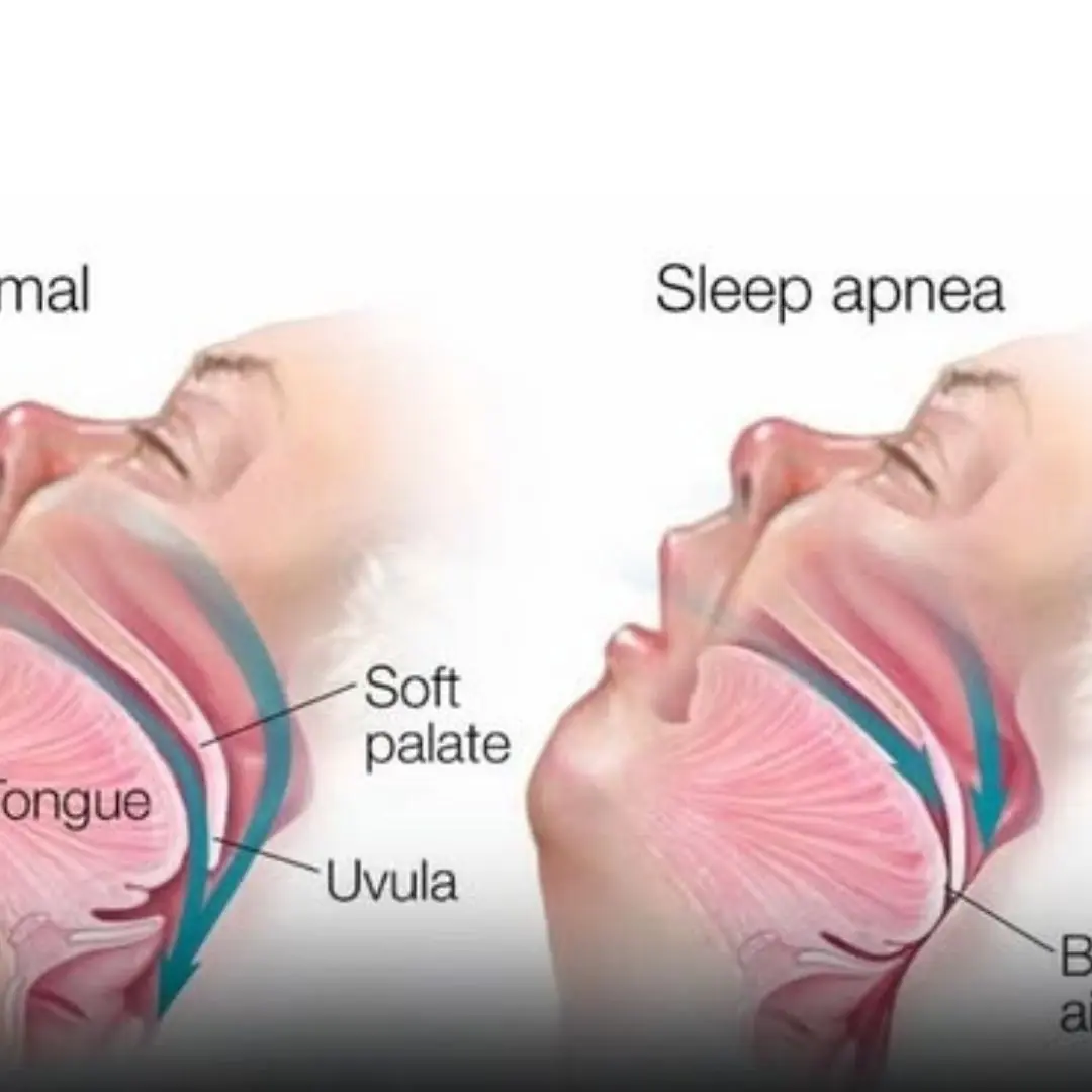 4 Signs You Might Have Sleep Apnea