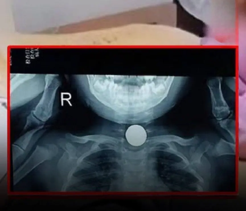 Tra.gedy strikes as 3-year-old girl di.es suddenly while playing with dad - A heartbrheaking reminder about cho.king ha.zards