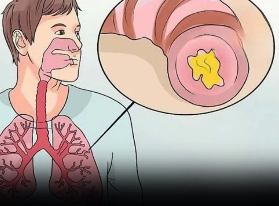 Symptoms of chronic bronchitis and treatment