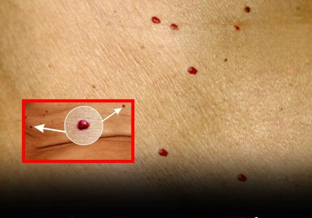 Spotted red dots on your skin? Here’s why they shouldn’t be ignored