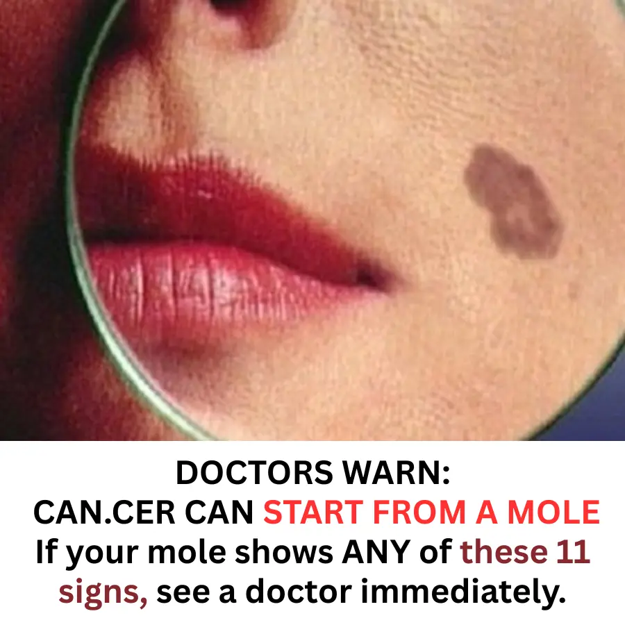 DOCTORS WARN: CAN.CER CAN START FROM A MOLE – SPREADS EXTREMELY FAST
