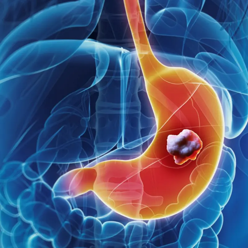 7 Serious Warning Signs of Sto.mach Can.cer in Its Later Stages