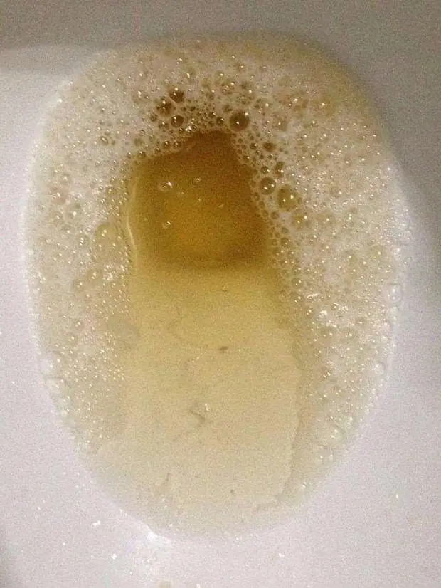Two Early Warning Signs of Kidney Damage: Morning Urine Color That Should Never Be Ignored