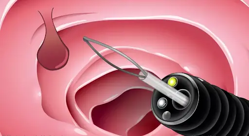 Spotting Colon Polyps Early: The Crucial Step in Preventing Colon Cancer