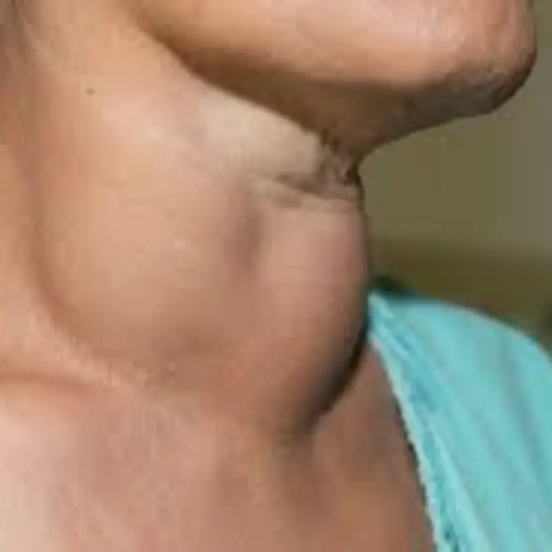 Avoid These 6 Foods That Can Harm Your Thyroid Health