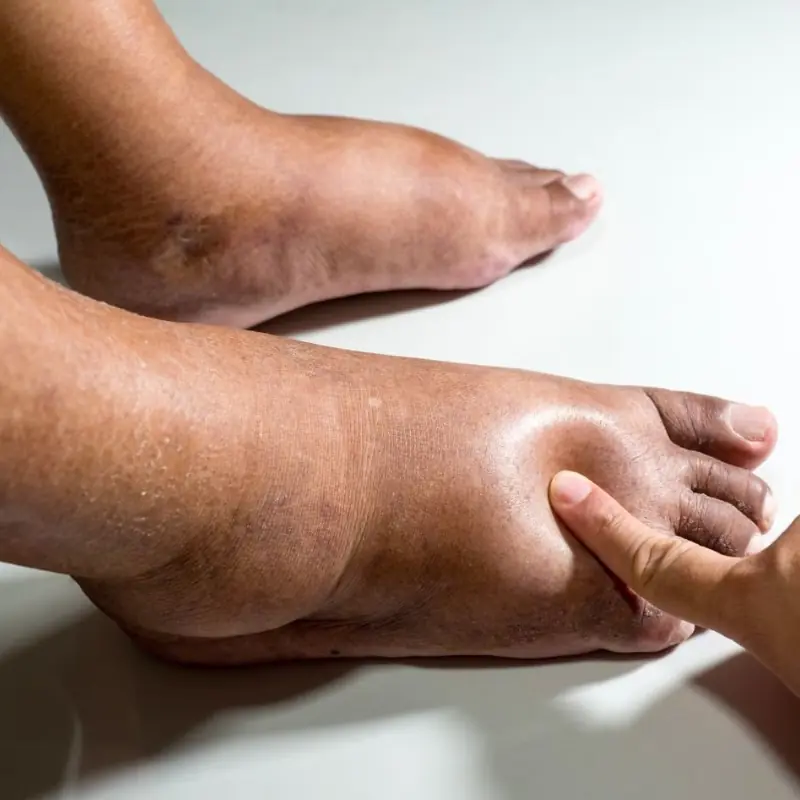 6 Simple Ways to Reduce Water Retention — and What Your Swollen Feet May Be Telling You