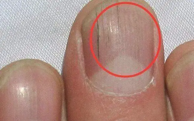 Check Your Nails for Warning Signs: If You Notice These 3 Changes, Consult a Doctor Right Away