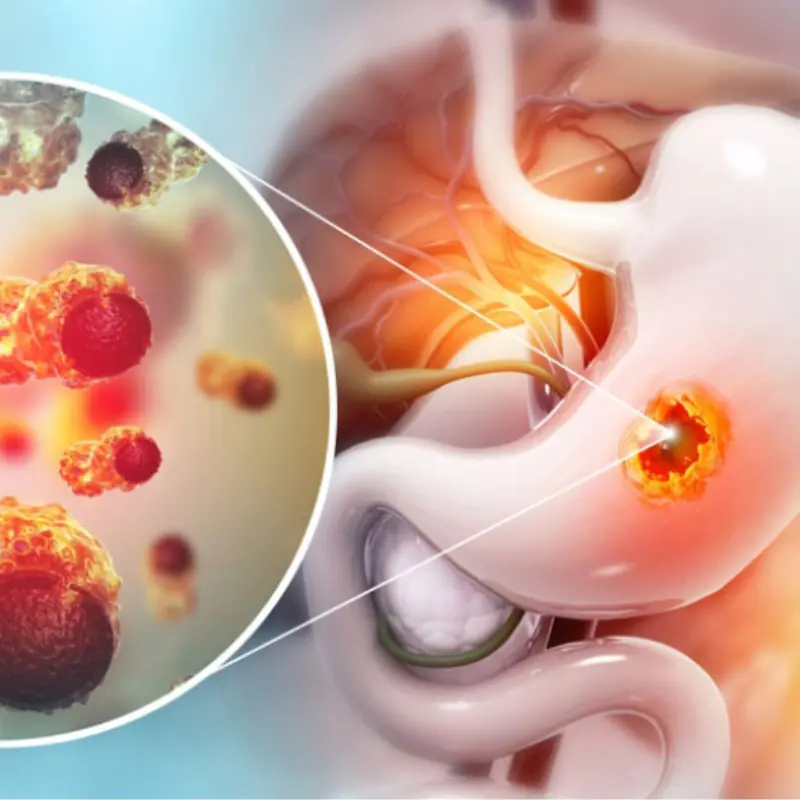 8 signs your sto.mach disease could be in a serious stage. If you notice any, see a doctor early.