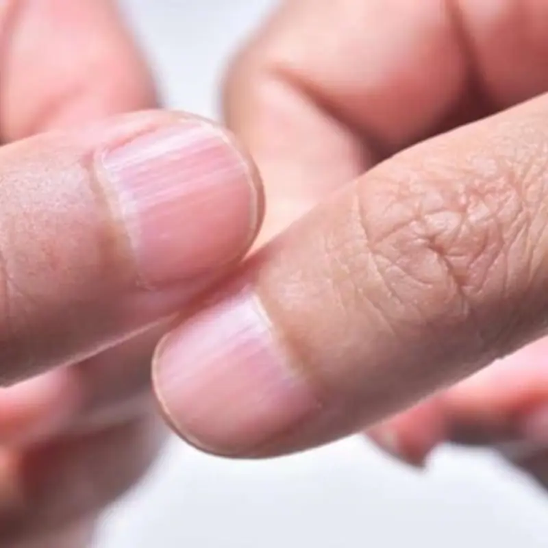 Three Warning Signs on Your Hands Could Point to Liver Trouble—Doctors Say Don’t Ignore Them