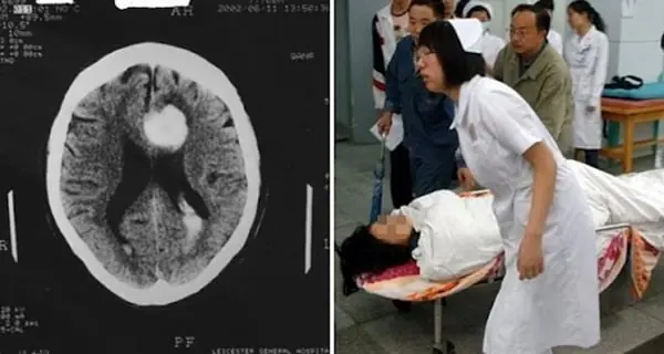 She Complained of a Headache, Fell Asleep—and Never Woke Up: Three Types of Headaches That Require Immediate Medical Attention