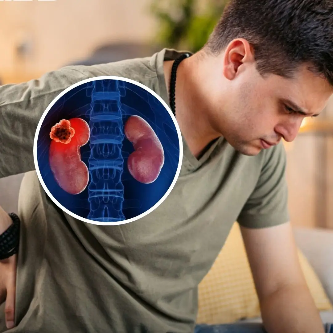 'Big three' ri.sk factors of kidney can.cer as symptoms are usually silent