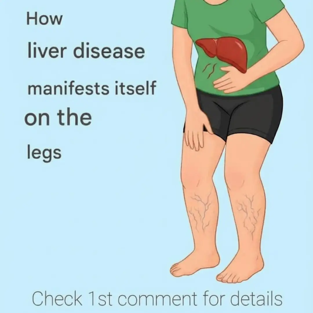 Your legs are screaming ‘HELP!:’ 5 warning signs from your liver