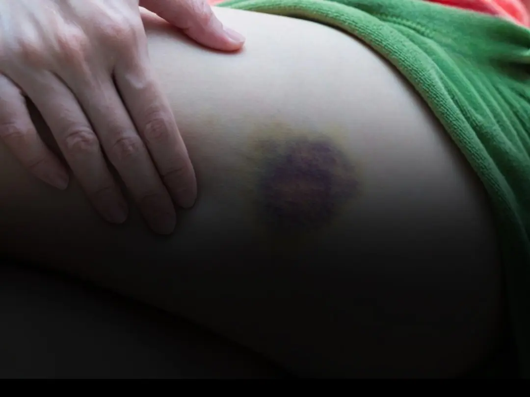 Warning signs you may have a brain hemorrhage, don't ignore them or you'll regret it too late