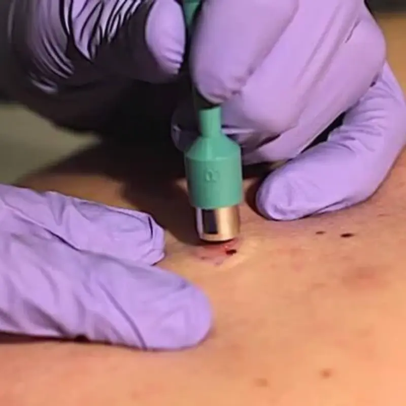 A small mistake led to a serious eye complication: Doctors warn of signs that may require can.cer screening