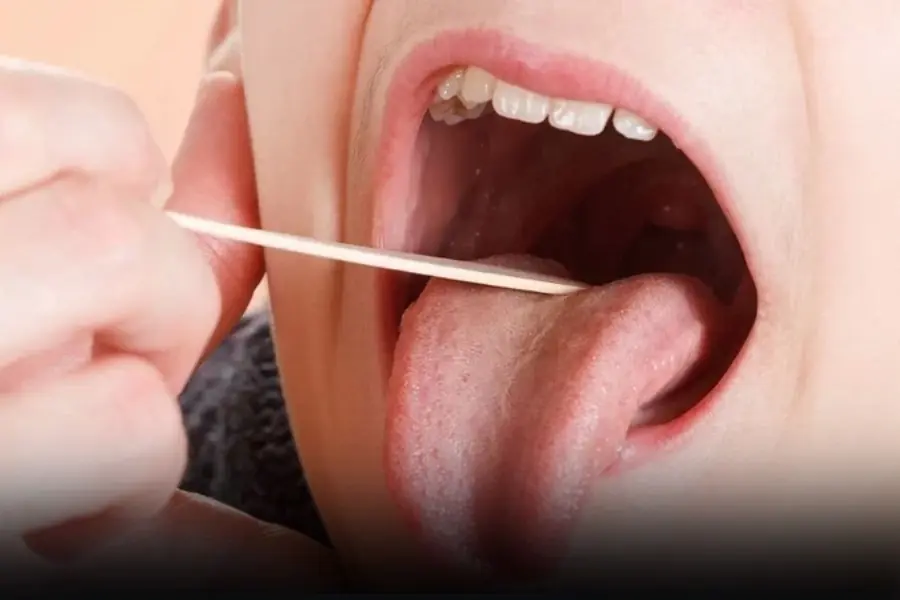 Mouth ulcers that did not heal for three months, went to the hospital for examination and discovered can.cer