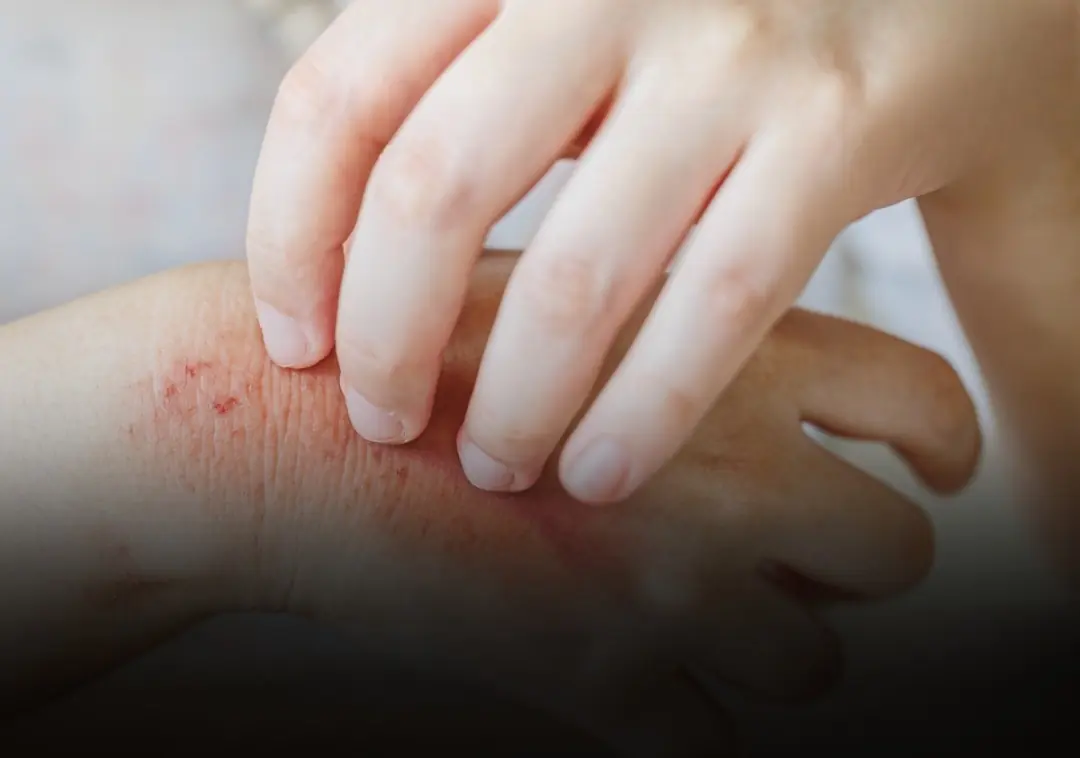 Surprising causes of hives revealed - What may be triggering your skin