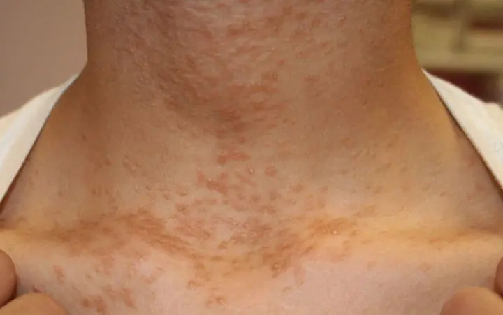 People at Risk of Can.cer Often Show 3 Unusual Signs in the Neck